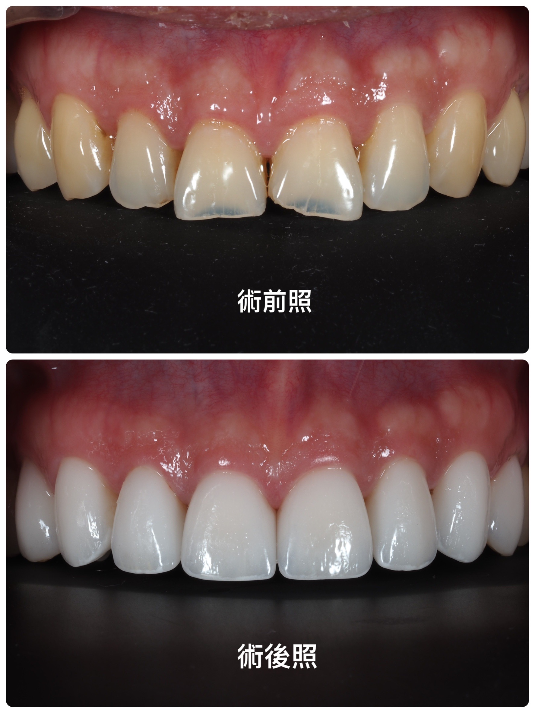 陶瓷貼片案例